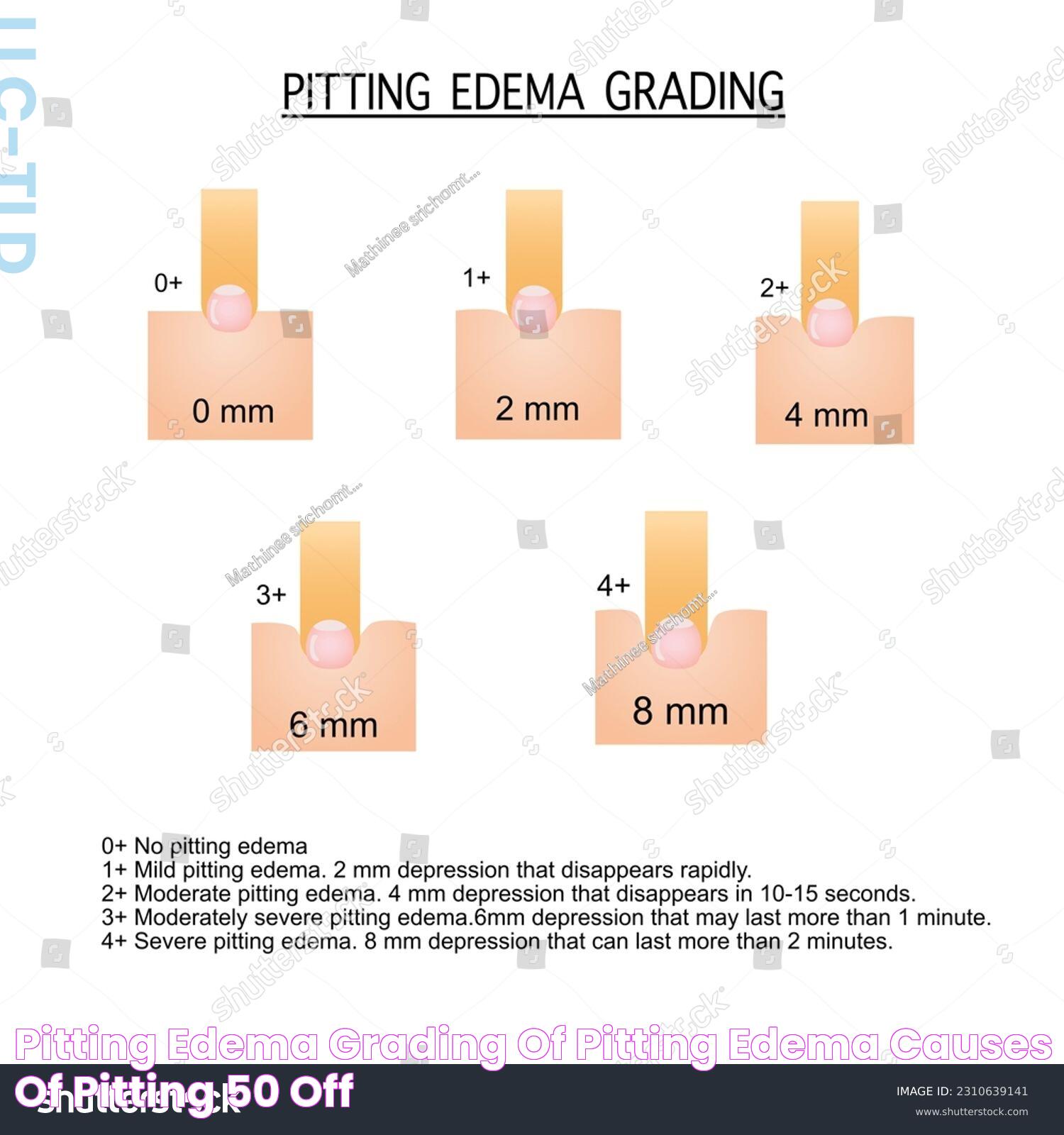 Pitting Edema Grading Of Pitting Edema Causes Of Pitting, 50 OFF