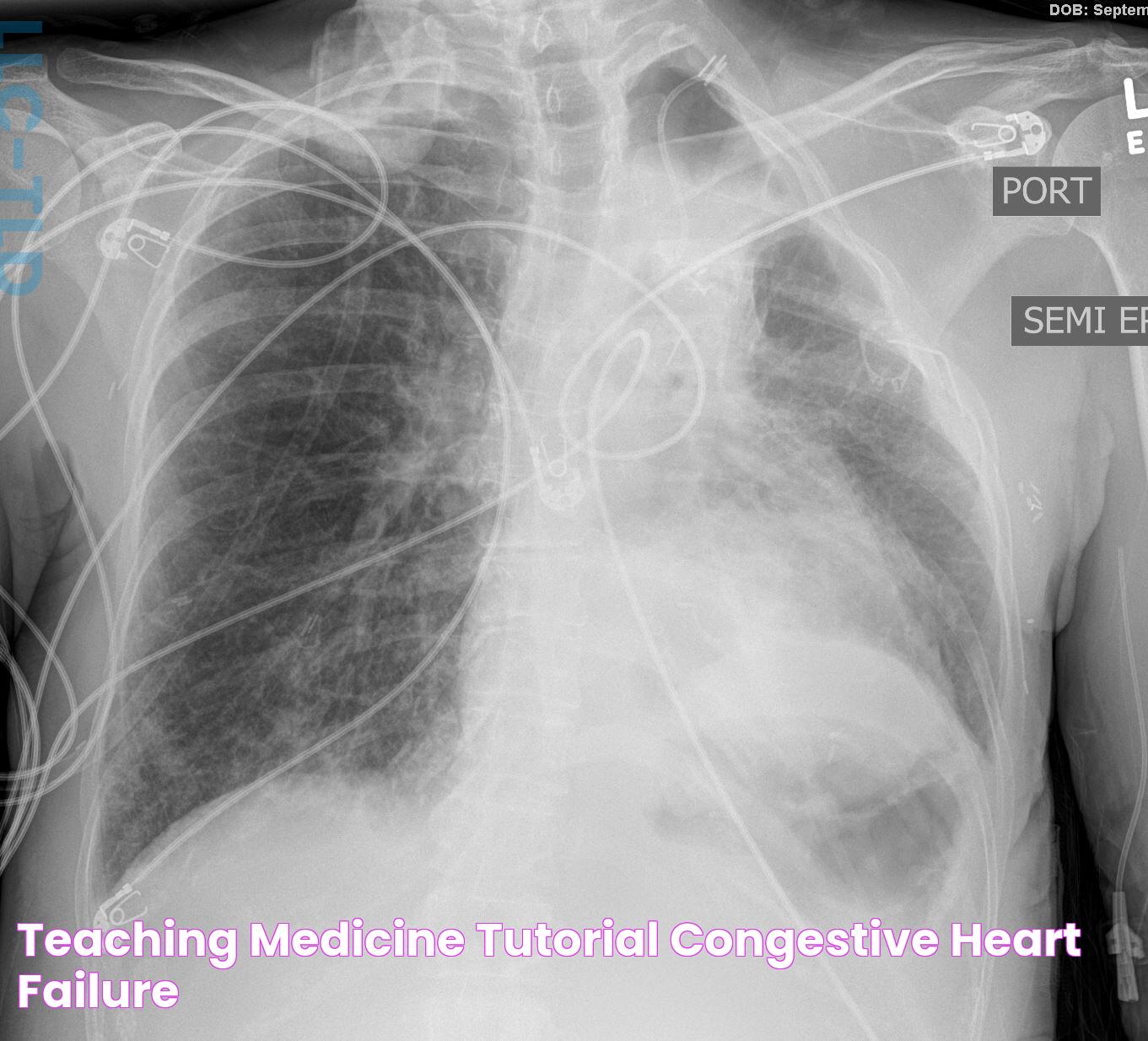 Kerley C Lines: A Detailed Guide To Understanding Their Significance