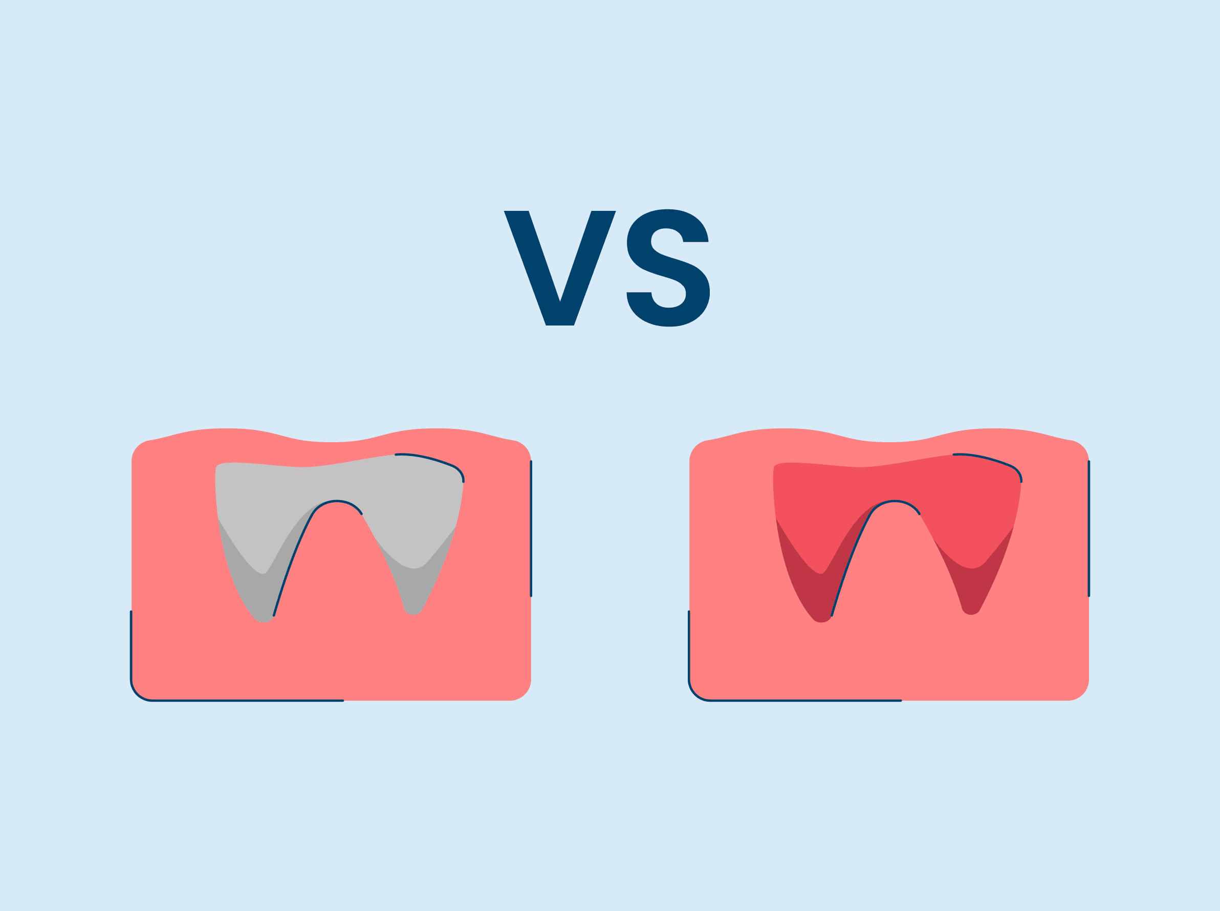 Dry Socket vs Normal Socket After Tooth Extraction