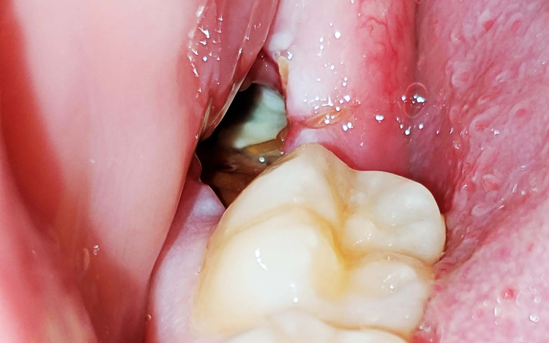 Pictures Of Dry Socket Vs Normal Healing: Understanding The Differences