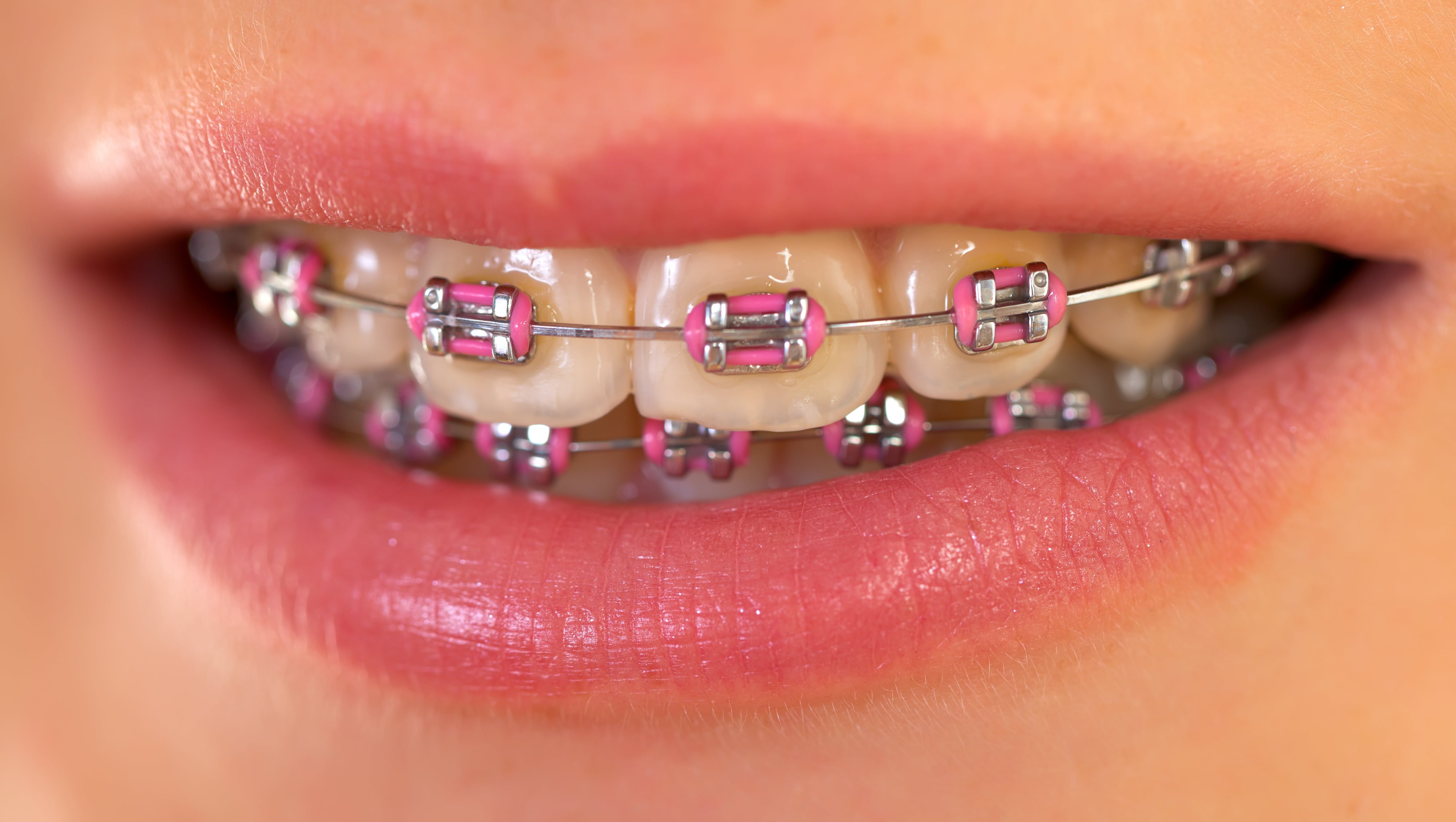 All You Need To Know About Pink Braces: A Stylish Smile Solution